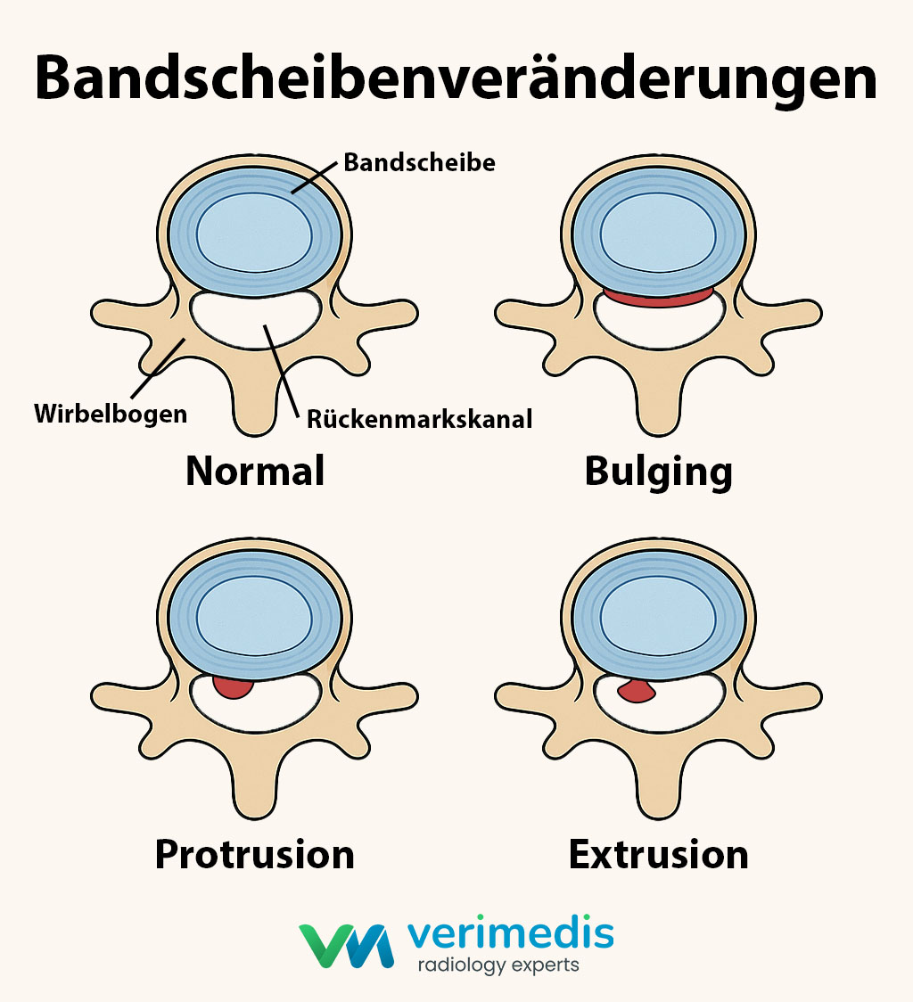 Grafische Darstellung der Bandscheibenveränderungen