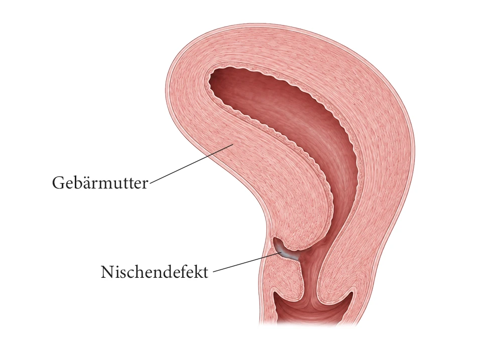 Schematische Darstellung eines Nischendefektes / einer Isthmocele des Uterus