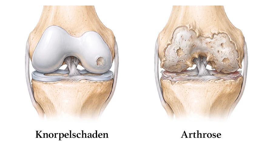 Bildlicher Vergleich zwischen einem Knorpelschaden und einer Arthrose des Kniegelenks