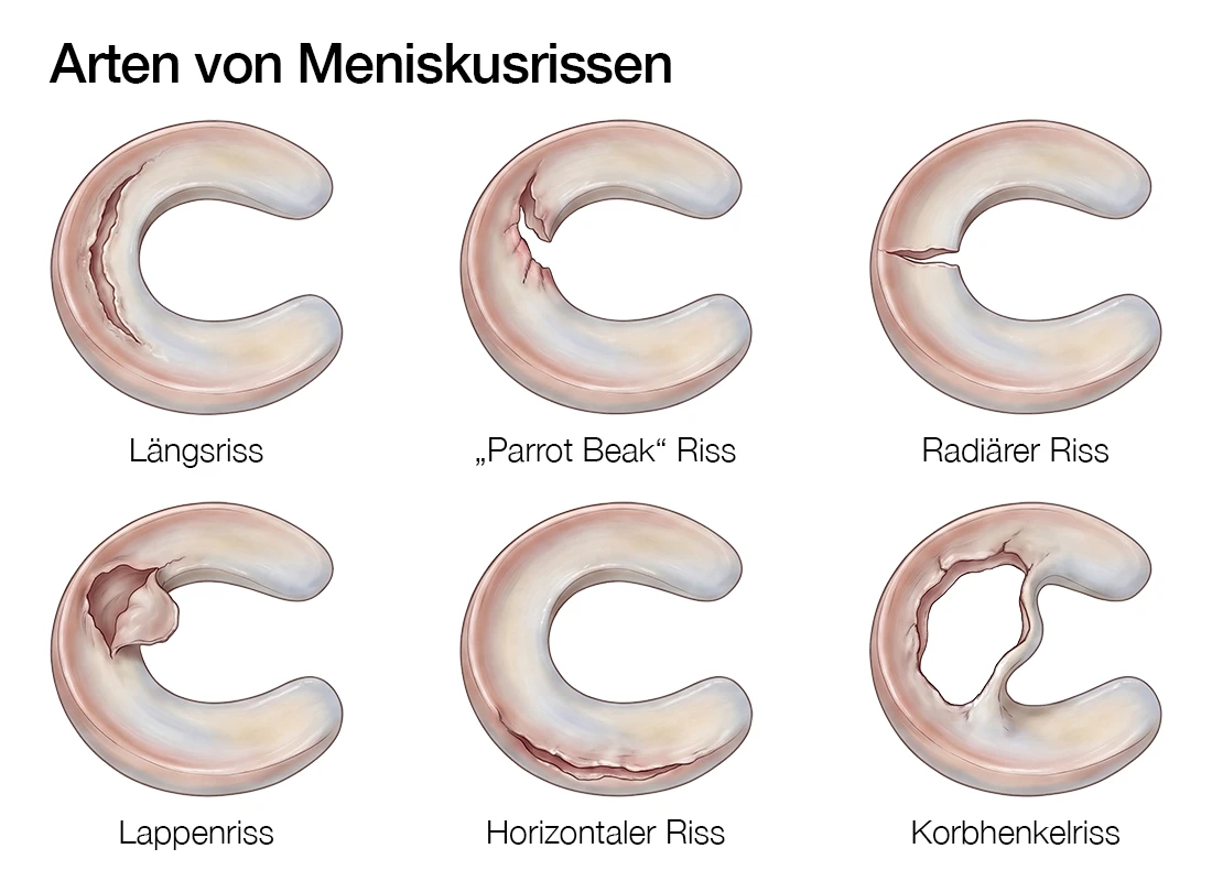 Schaubild der verschiedenen Arten von Meniskusrissen.