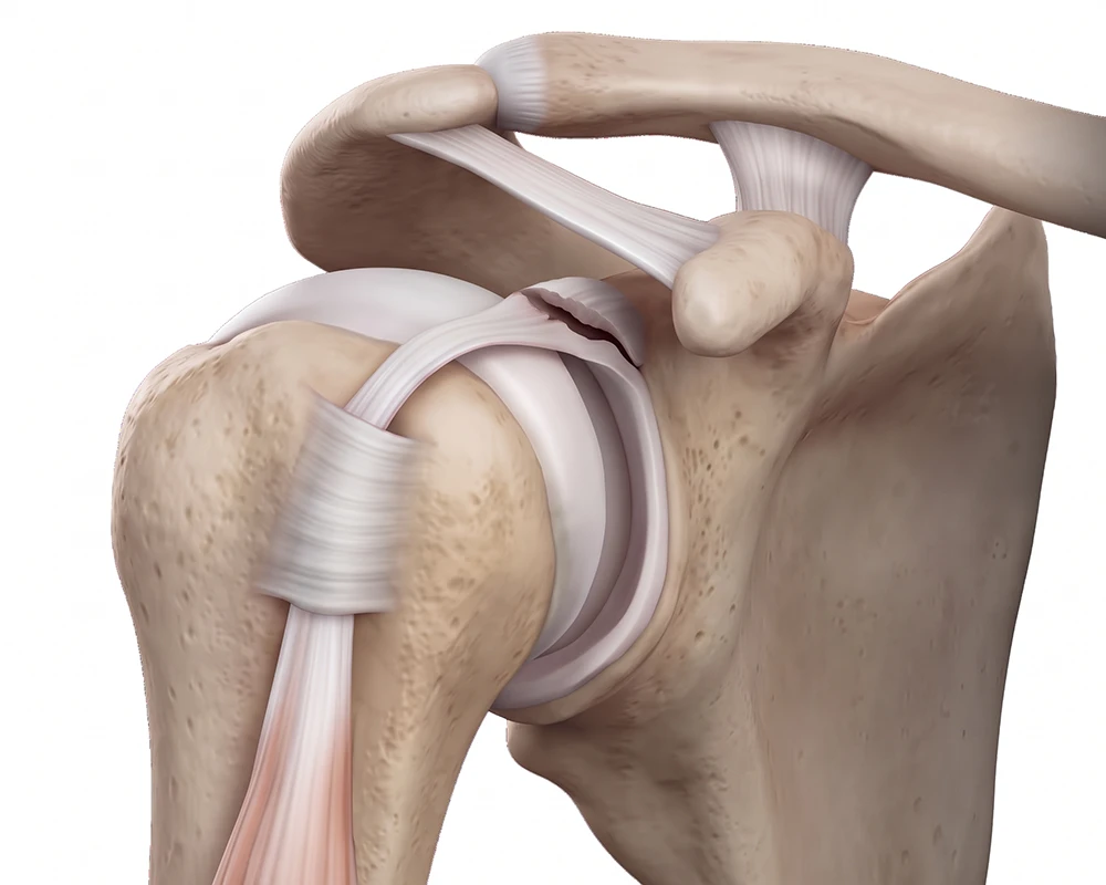 Anatomische Illustration eines Einrisses des Ankers der langen Bizepssehne
