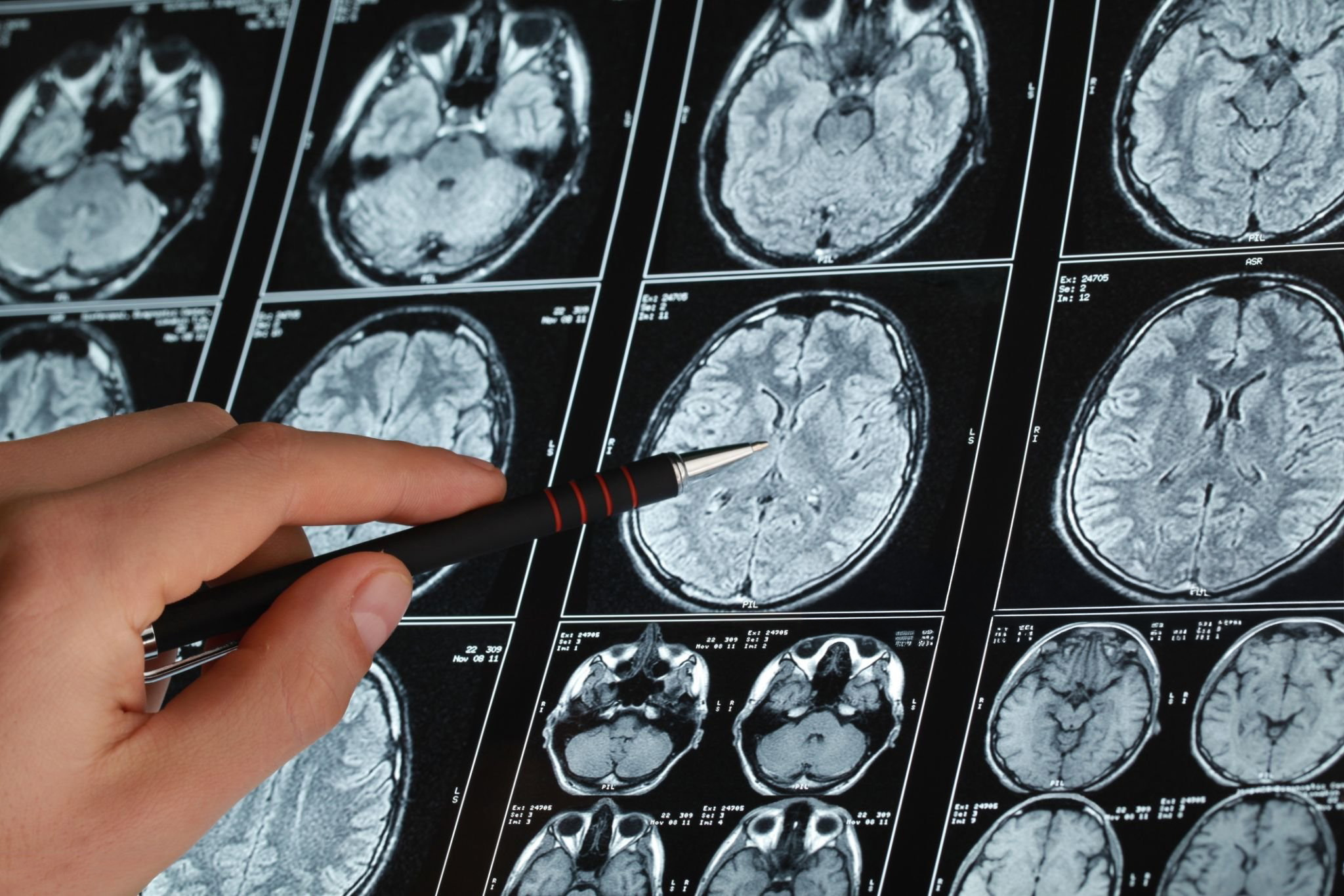Neuroradiologie